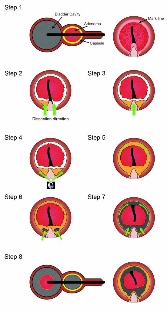 大型攝護腺銩雷射宛除手術研究，獲BMC Urology刊登 2